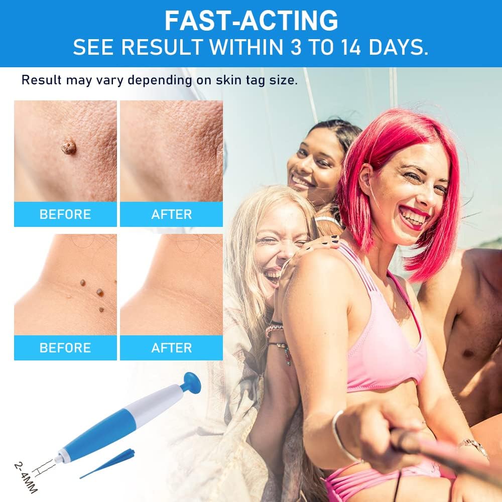 Auto Skin Tag/Warts Remover Painless